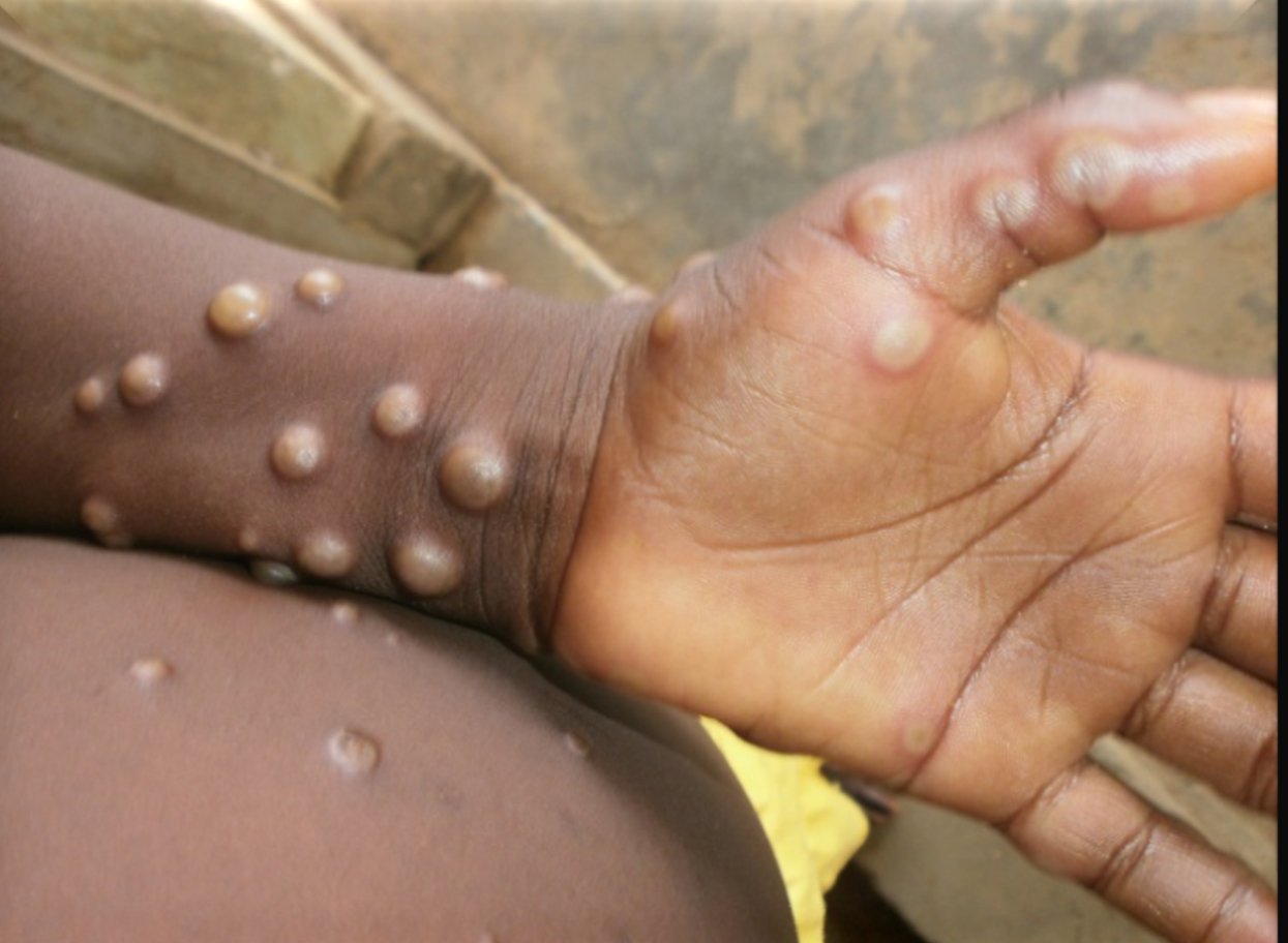 Plans Are In Place To Stock Up On Treatments For Monkeypox In Case Infections Rise, London's Public Health Regional Director Has Said