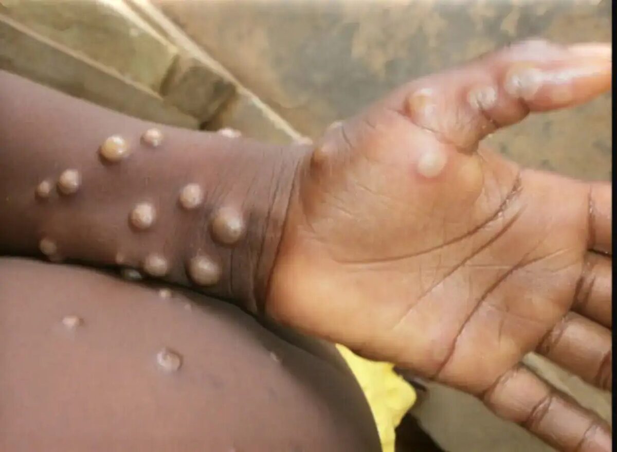 Monkeypox Hits London: Seven UK Cases Confirmed as Health Chiefs Ramp Up Vaccines and Vigilance