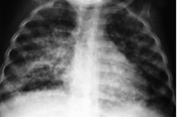 Progress Towards Tb Elimination Has Stalled