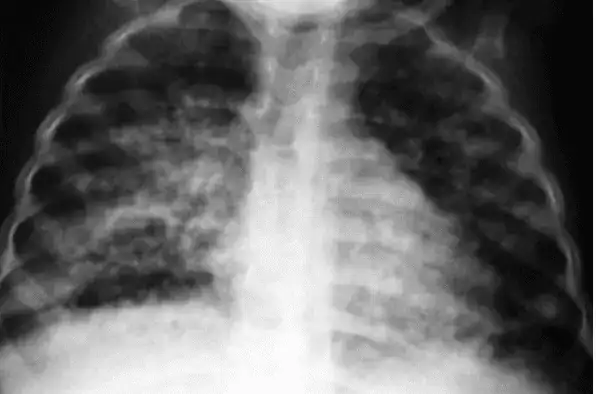 TB Crisis Worsens in England’s Poorest Areas as Progress to Eliminate Disease Stalls