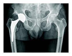 A Technique For Measuring The Cardiac Risk Associated With Cobalt-containing Hip Replacements Has Been Highlighted For The First Time In Research At The University Of Strathclyde.