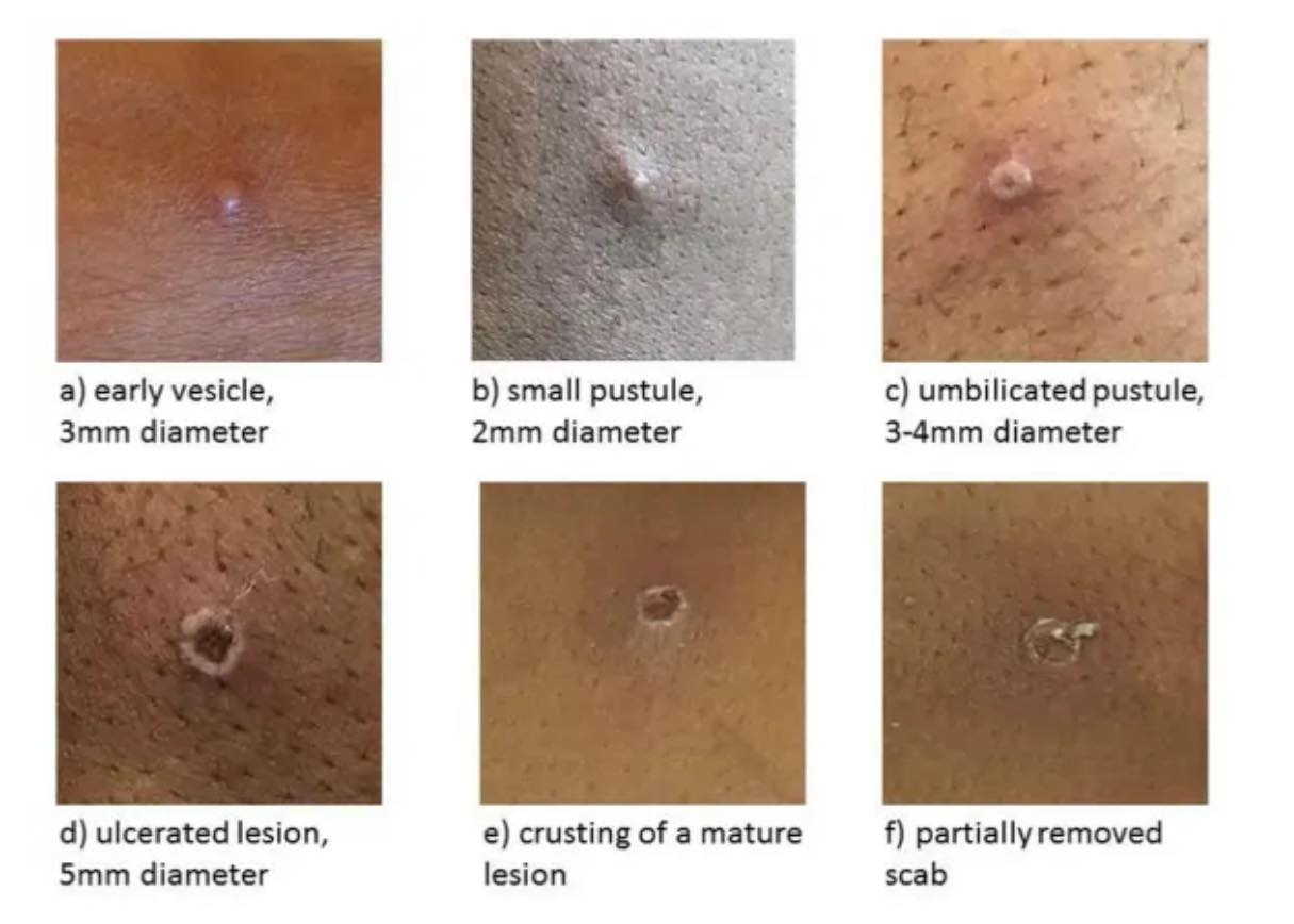 Further Cases Of Monkeypox Are Being Confirmed "on A Daily Basis" In The Uk, A Chief Medical Adviser Has Warned