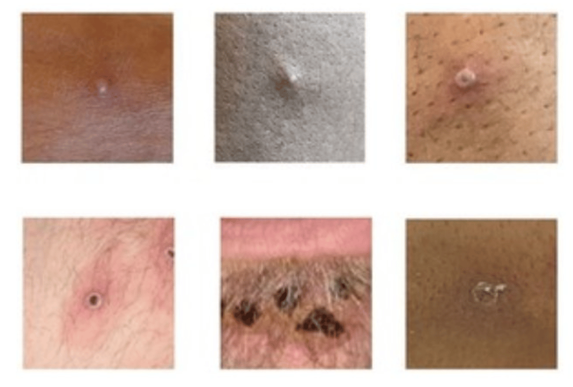 The Uk Health Security Agency (ukhsa) Has Identified 46 New Cases Of Monkeypox In England, Three In Scotland, And One In Wales