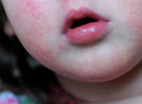 According To The Uk Health Security Agency, The Number Of Children Under The Age Of 15 Who Have Died From Strep A In The Uk Has Risen To 15