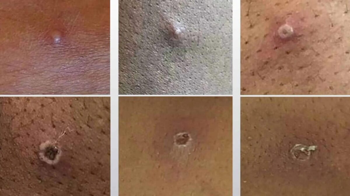 Monkeypox Cases Surge in Kent’s Thanet and Medway as Infections Rise Across England