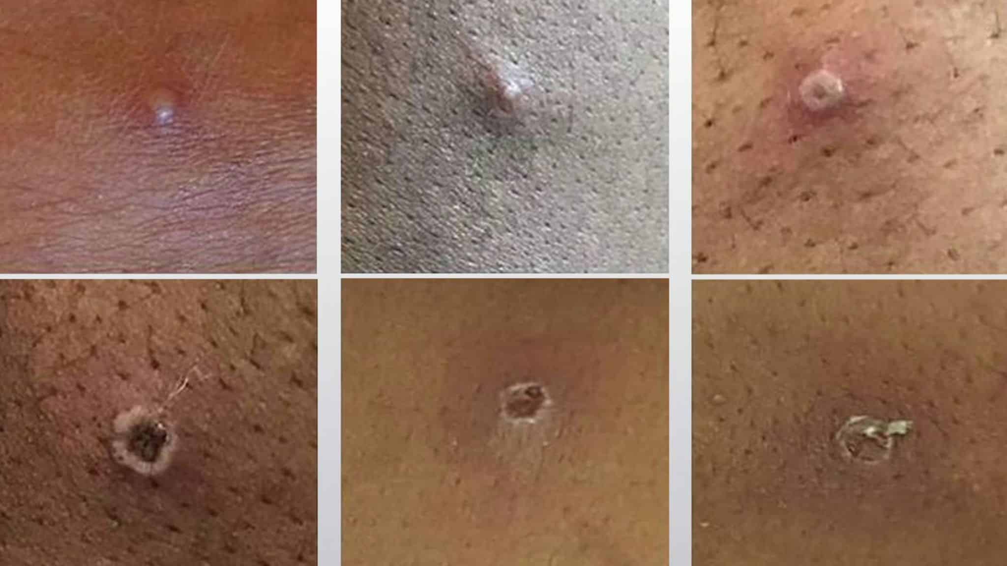 This Week, Suspected Monkeypox Cases Have Been Reported In Kent.