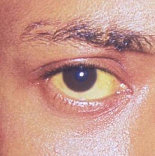 The Uk Health Security Agency (ukhsa) Has Released Its Fourth Technical Briefing, Which Details Investigations Into An Increase In Cases Of Childhood Hepatitis