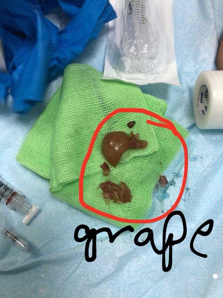 Two Year Old Brought Back To Life After Chocking On A Grape