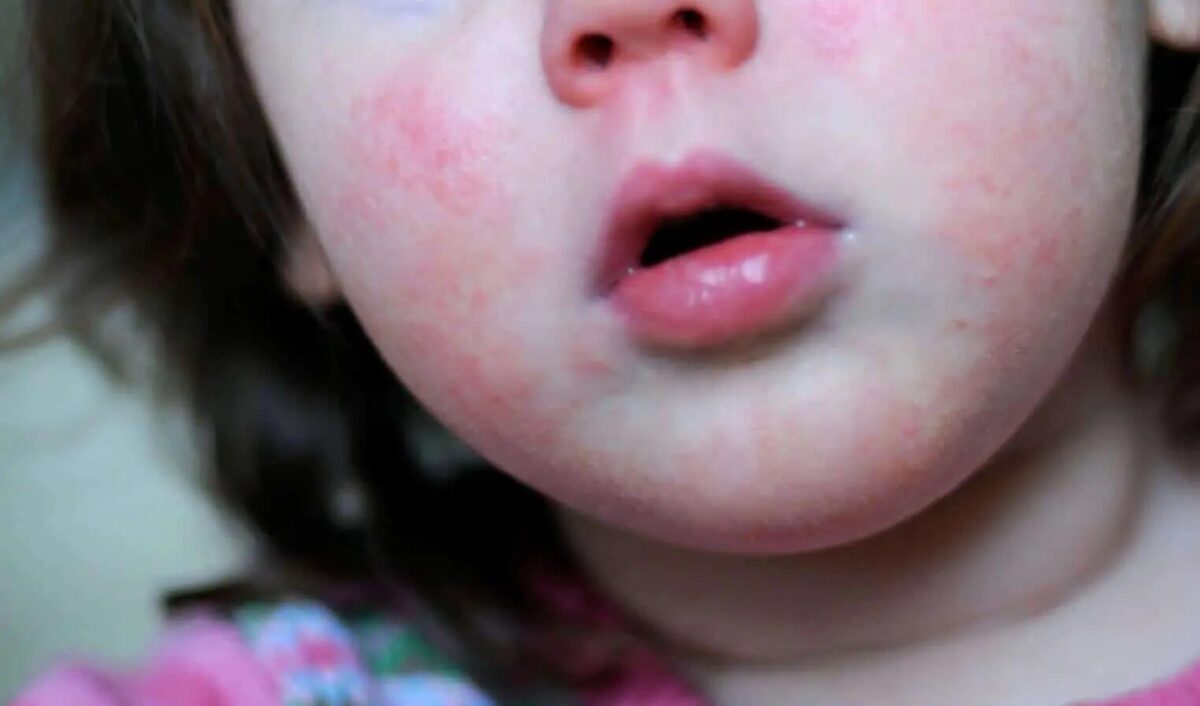 Two Children In Scotland Have Died With The Strep A Infection, Figures Show