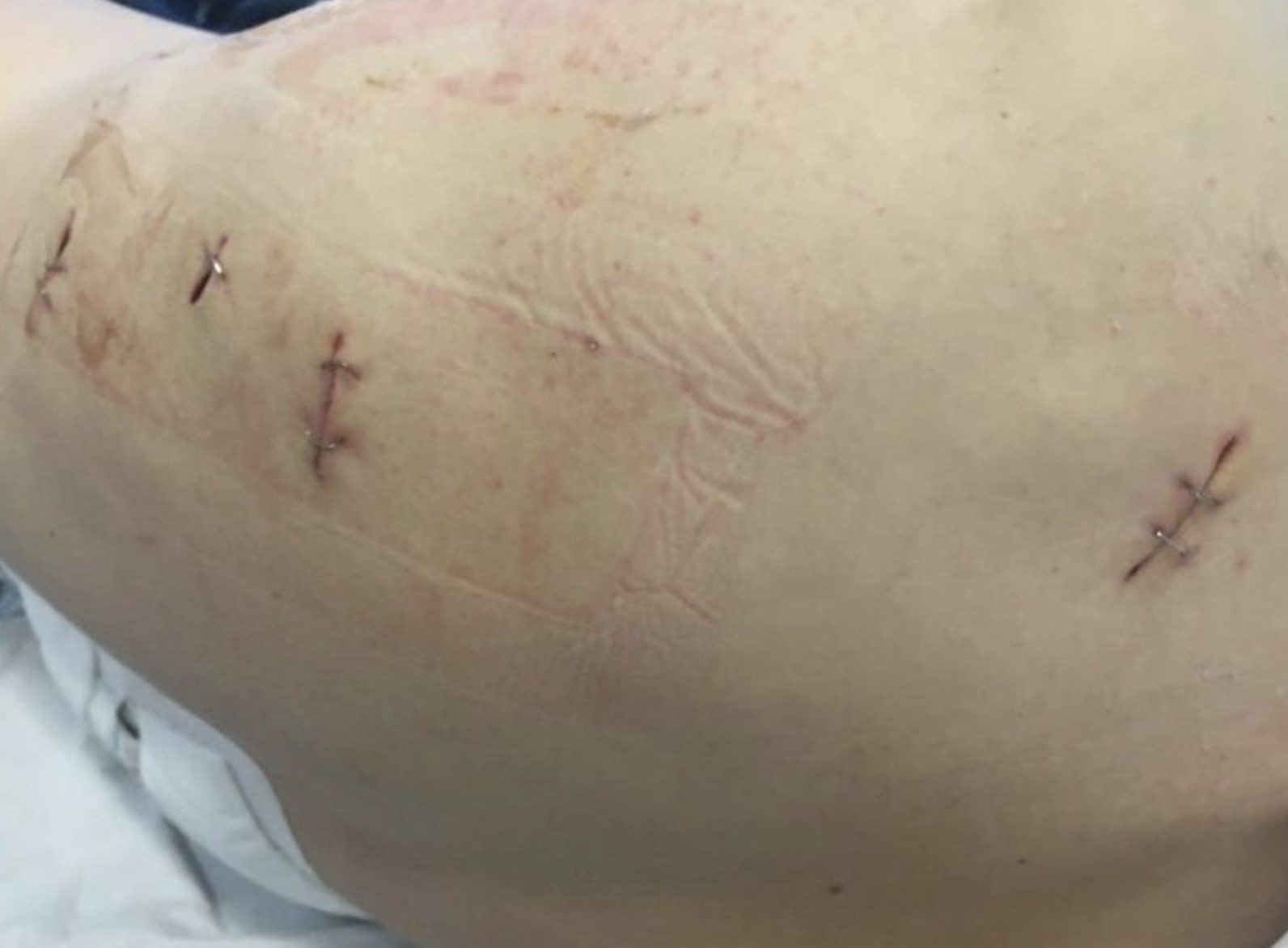 Two Men Have Been Jailed For A Combined 17 Years For Their Roles In A Savage Attack On A Man Which Required Him To Have A Kidney Removed