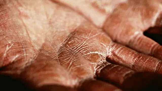 New York Medical’s Breakthrough Study Reveals Berberine’s Potential in Eczema Treatment