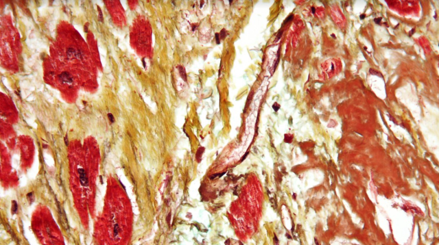 Nanoparticles Show Promise in Treating Skin and Lung Fibrosis