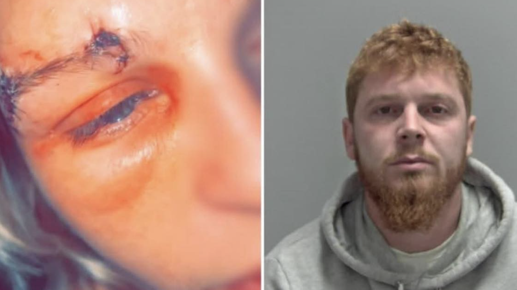 Man Who Tried to Bite Out Pregnant Fiancée’s Eyeball Recalled to Prison