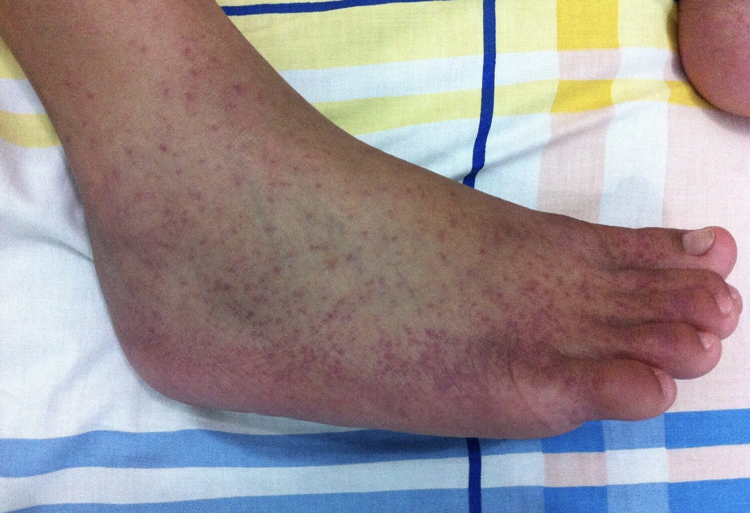 Chikungunya Virus Outbreak in China: How Severe is it and Could it Spread to the UK?