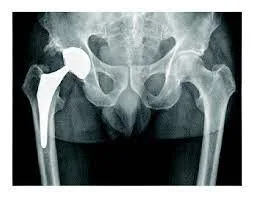 A Technique For Measuring The Cardiac Risk Associated With Cobalt-containing Hip Replacements Has Been Highlighted For The First Time In Research At The University Of Strathclyde.