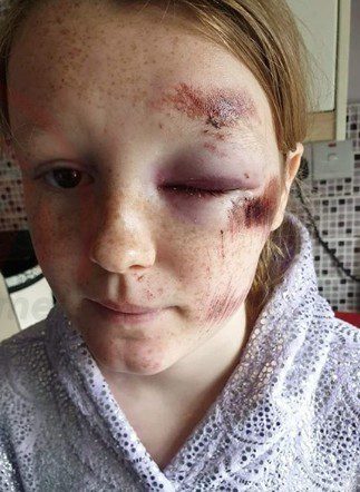 Hit And Run Leaves In Southampton Leaves Teeneager With Facial Injuries