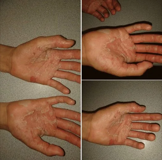 Isle of Wight Dad Sounds Alarm After Daughter’s Homemade Slime Causes Chemical Burns – Parents Must Beware!