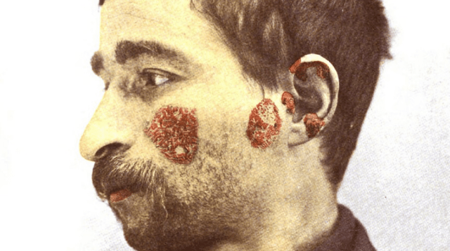 Steroid Crisis: 91% of Lupus Patients Face Severe Side Effects Amid Long-Term Use, Survey Reveals