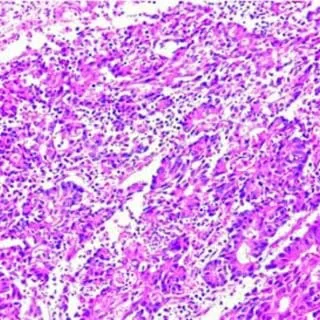 UK Approves Enhertu for Wider Use in HER2-Positive Tumours, Offering New Lifeline for Advanced Cancer Patients