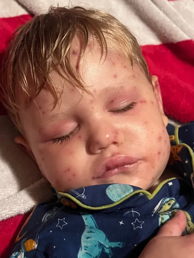 Toddler Stung 150+ Times by Yellow Jackets in Georgia Backyard Fight for Life
