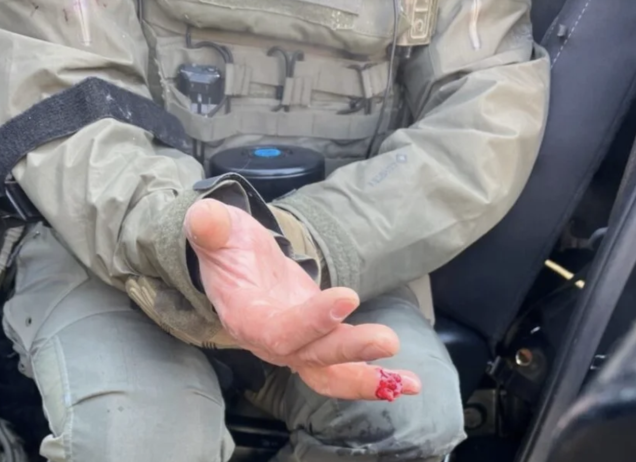 Homeland Security Officer Loses Finger After Minneapolis Riot Bite-Off