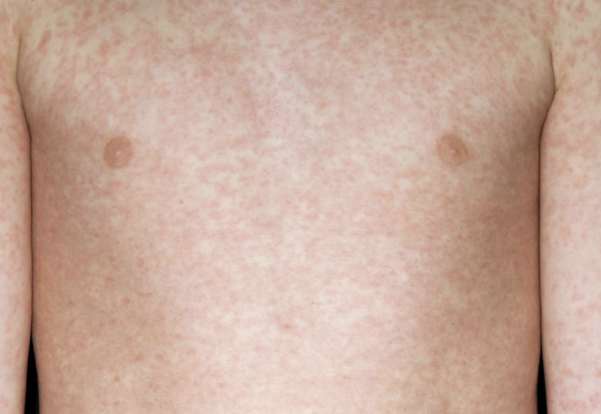 Two Children Die from Measles as Cases Surge Across UK