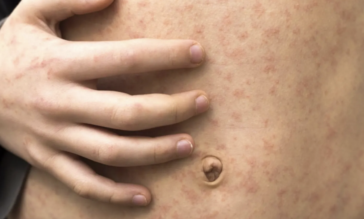 Health Chiefs Warn as Measles Cases Surge in England
