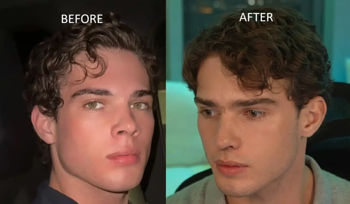 Clavicular Faces Backlash After Nose Job Live-Streamed to Millions