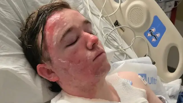 McDonald’s Worker in ICU After Co-Worker Throws Hot Oil in Assault
